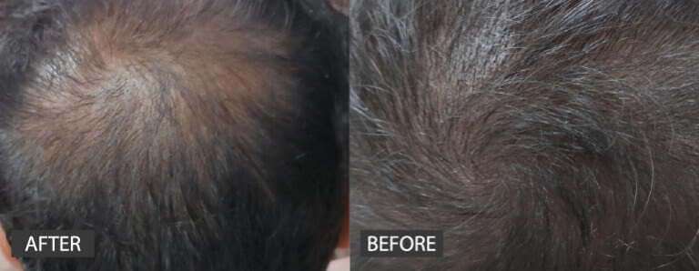 Hair Transplant in Ahmedabad | Skin Care - Trichohom