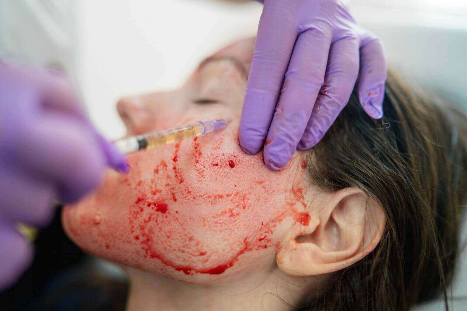 facial vampire trichohom ahmedabad